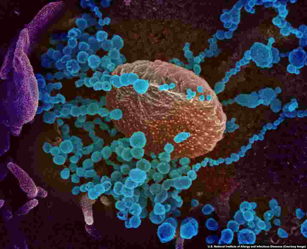 Вирионы SARS-CoV-2, разрастающиеся в клетке человеческого организма. Все фотографии в этой галерее раскрашены с использованием специальных программ, включая Photoshop.